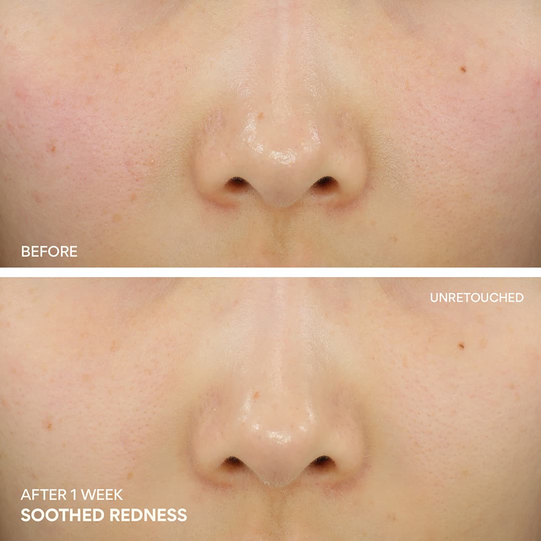 Green Tea Ceramide Cream soothes redness after using it for 1 week