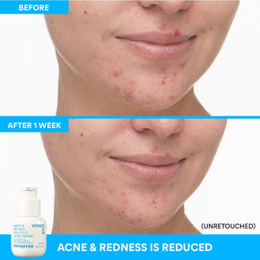 Gentle Retinol Salicylic Acne Serum