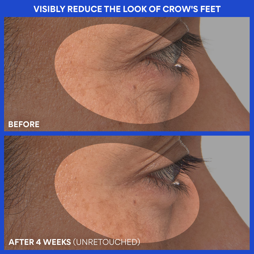 Before and after comparison of crow's feet reduction on a person's eye area.