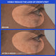 Enlarge image of Before and after comparison of crow&amp;#39;s feet reduction on a person&amp;#39;s eye area.