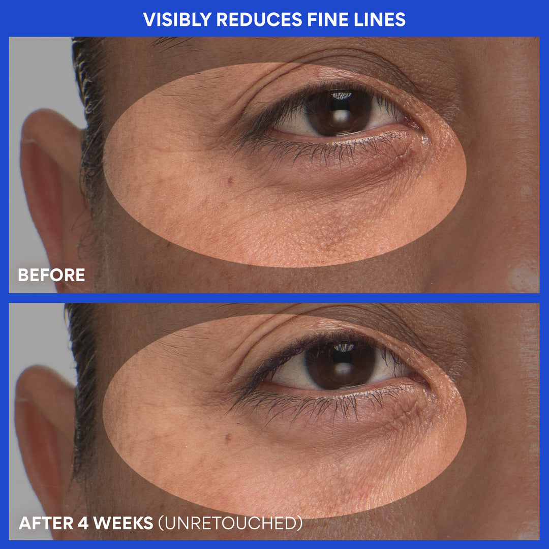 Before and after comparison of fine lines around an eye, showing a reduction over 4 weeks.