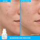 Enlarge image of Gentle Retinol Salicylic Acne Serum