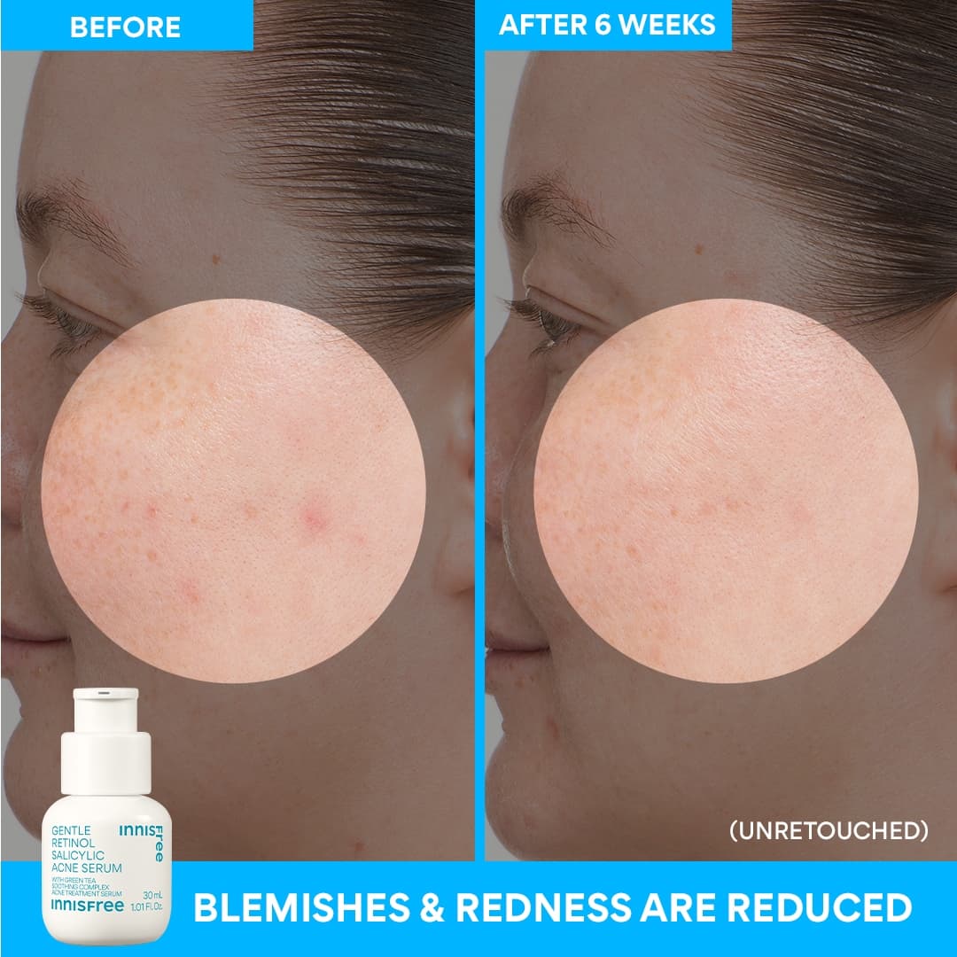 美容液 r.deal acne treatment serum 30ml Bubble Skincare Super Clear Acne Treating Serum, 30 mL