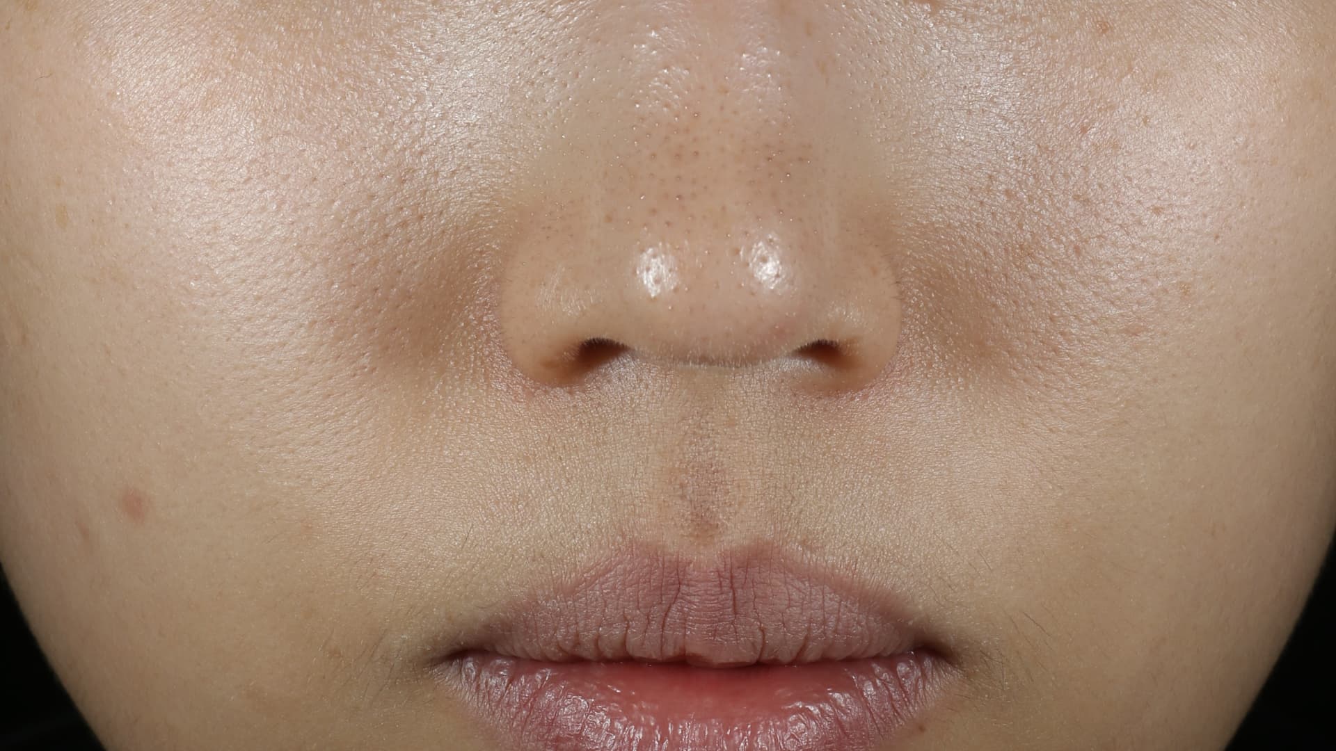 Retinol Green Tea PDRN™ Skinbooster Tone before results