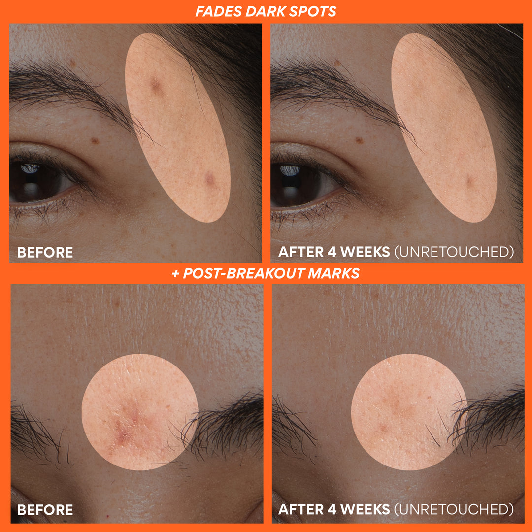 Before and after comparison of dark spots on skin 