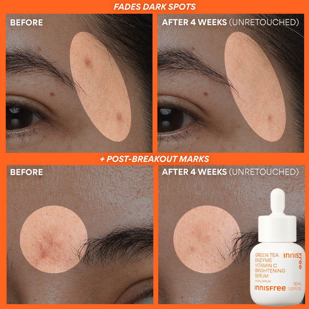 Before and after comparison of fading dark spots and post-breakout marks on skin with Vitamin C Brightening Serum