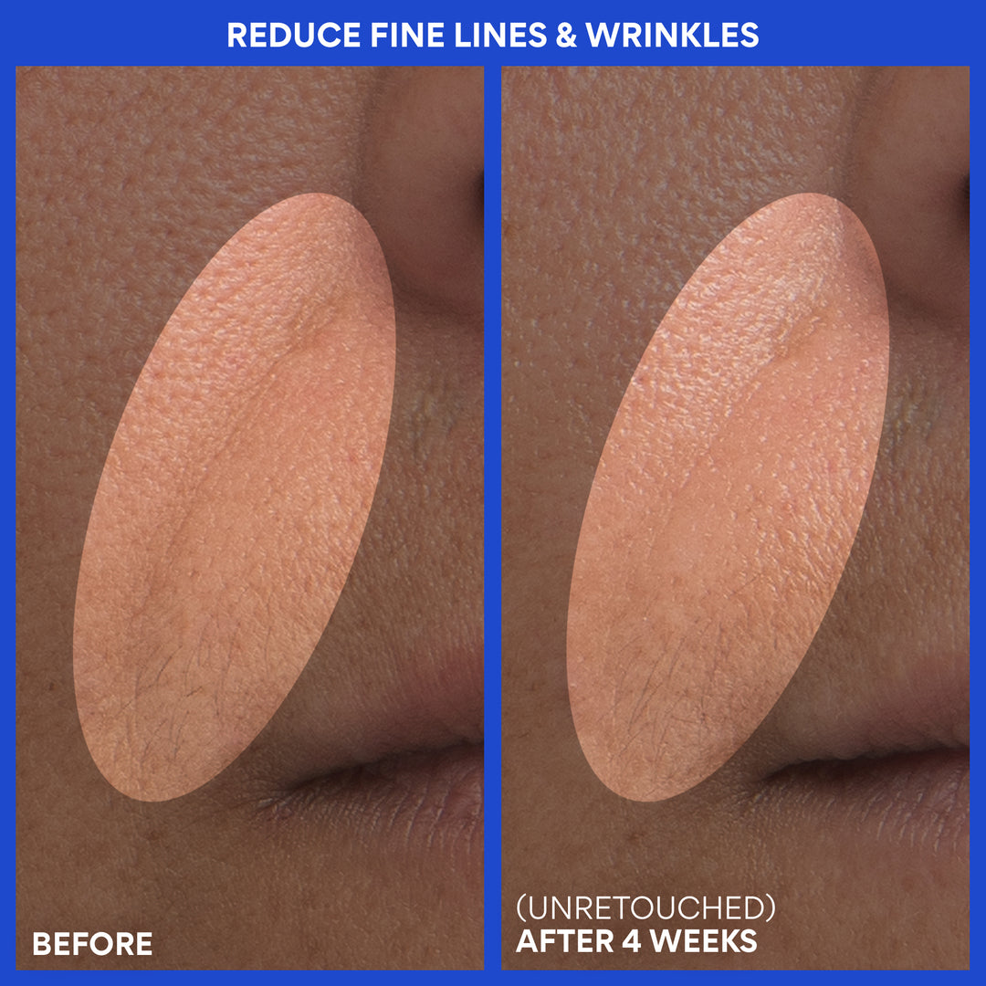 Retinol Green Tea PDRN™ Firming Serum before and after 4 weeks: reduce fine lines & wrinkles