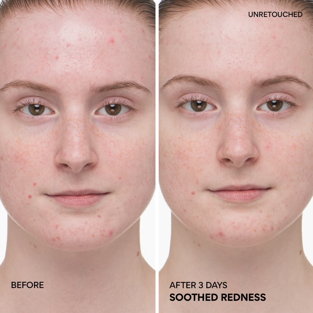 Green Tea Ceramide Milk before and after 3 days, soothed redness