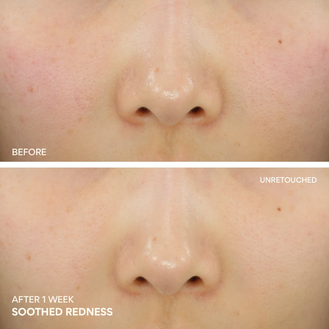 Green Tea Ceramide Cream before and after 1 week, soothed redness
